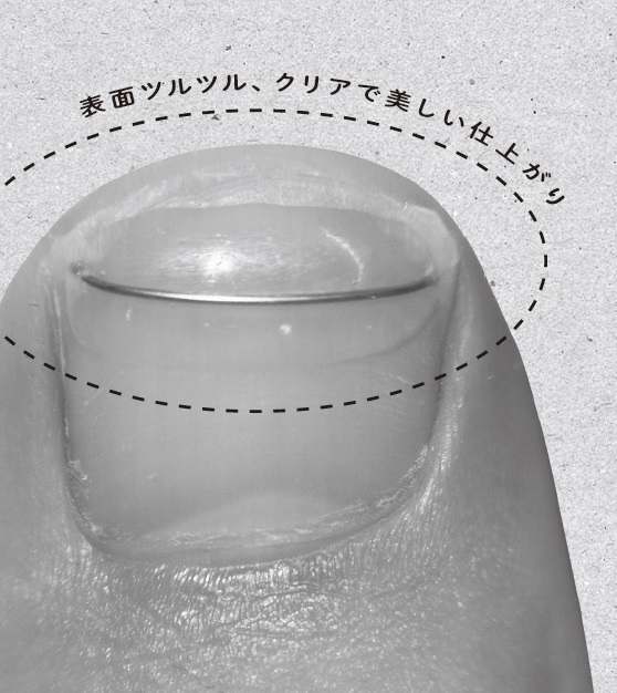 痛みがない」と好評！ 「巻き爪」矯正を最新調査 | ananニュース